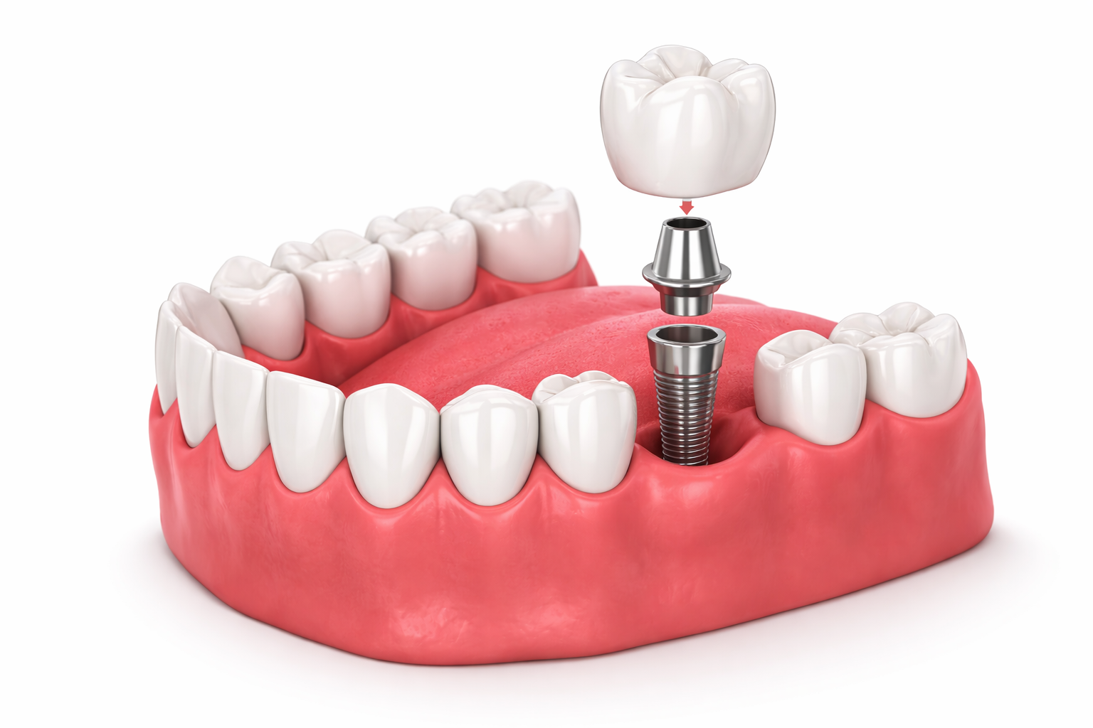 Dental implants in Ashburn, VA